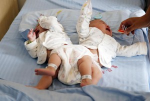 С помощью 3D-технологий в Китае успешно разделили сиамских близнецов