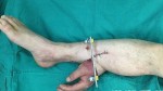 В Китае хирурги пришили руку пациента к ноге