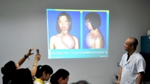 В Китае женщине на груди вырастили лицо