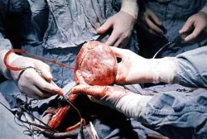 transplantacia