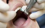 Китайцы изобрели «умный зуб» для похудения